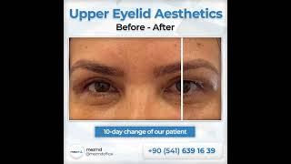 Upper Eyelied (Blepharoplasty) Surgery - Before & After | mezMD Health Tourism Agency