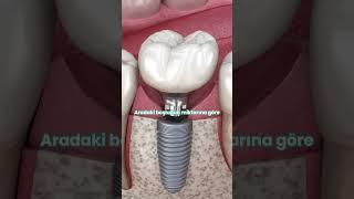 2 Diş Arası Boşluklara Çözüm Önerileri #dişestetiği #implant  #denizlidişhekimi