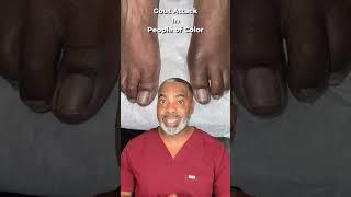 Gout Attack In People of Color