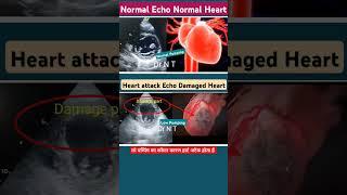 Normal V/S Heart attack Echo l हार्ट अटैक इको l #echo #heartattack #shorts