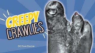 Creepy Crawlies: Saving A Diabetic Foot