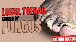 Loose Toenail Caused By Fungus