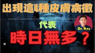 (中英字幕EngSub) 皮膚上出現這四種症狀，代表時日無多？4 skin signs of advanced cancer