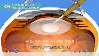 中大眼科譚智勇教授：白內障手術全面睇