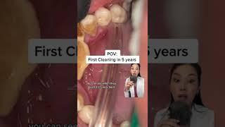 5 years of plaque build up. Get your cleanings! #plaque #tartar #buildip #dentist #dentistry