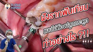 ฝังรากฟันเทียมโดยไม่ปลูกกระดูก พี่หมอทำอย่างไร ?! | คลายปัญหารากฟันเทียมกับหมอโชค