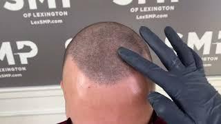 Density-Fill | Lexington Scalp Micropigmentation (SMP)