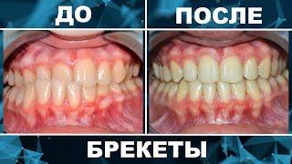 Брекеты до и после. Исправление прикуса за 14 месяцев.