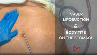 Vaser Liposuction and BodyTite on the Stomach | Dr. Shalini Gupta