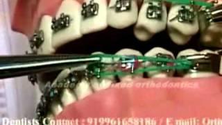 Cl I Elastics in Orthodontics