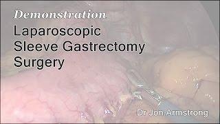 Sleeve Gastrectomy Surgery Overview - Advance Surgical Perth