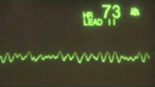 Ventricular Fibrillation - ECG Training Tutorial