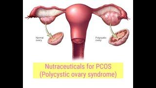 Nutraceuticals for PCOS (Polycystic ovary syndrome)