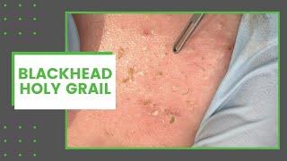 Blackhead Holy Grail | Dr. Derm