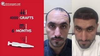 Hair Transplant Before And After | Clinicexpert