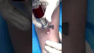 손목 레옹 문신(타투)제거 ASMR - ALL 수면마취 [Laser Tattoo Removal]