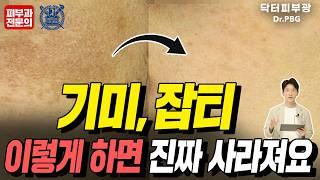 기미, 잡티, 흑자 없애는 방법 - 피부과전문의 닥터피부광