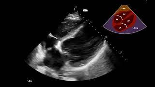 Cardiogenic Shock Case 2:  Part 2 - Explanation