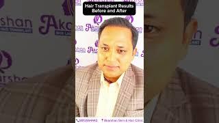 Hair Transplant Before and After: Amazing Transformations!  #hairtransplantresults  #akarshan