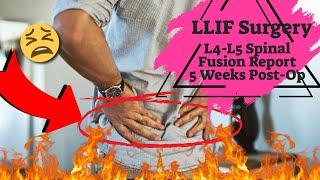 Lateral Lumbar Interbody Fusion (LLIF) L4-L5 -  5 weeks post-op-LLIF Lateral Lumbar Interbody Fusion