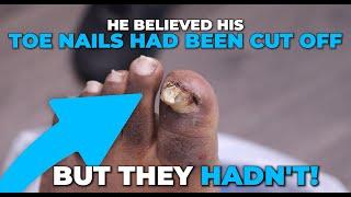 HE THOUGHT HIS NAIL WAS CUT OFF BUT IT WASN'T?!