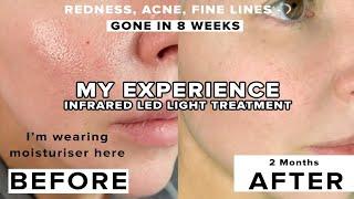 It took 8 weeks & it was gone: REDNESS, PIGMENTATION, PORES. Black Friday Exclusive, hurry ends soon