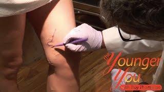 The Younger You Episode - 42 Varicose Veins