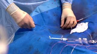 How to use a torqueable Microcatheters