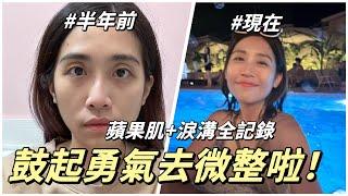 全身都在抖微整值得嗎？醫美小白的半年全記錄！淚溝+蘋果肌