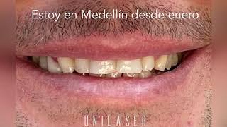 Veneers Dental Procedure at Unilaser