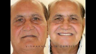 Full mouth implant supported fixed dentures