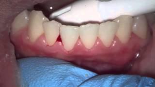 evaluating bleed gums