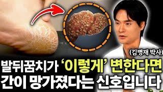 "단순 각질이 아닙니다" 간 건강이 위험할 때 발에서 보내는 '이 신호'. (김병재 박사 3부)