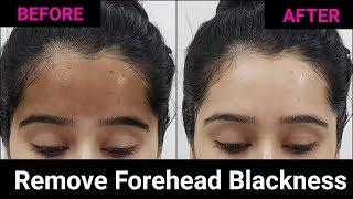 Get rid of Black Forehead + Whiten & Brighten your Skin Naturally