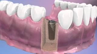 Implantes dentales - BQDC | Qué son, cómo se colocan...