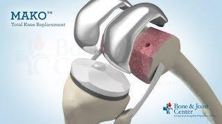 Full Knee Replacement | Mako Robotic Arm Assisted Surgery Technology