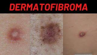 Dermatofibroma Causes, Symptoms, What is it? How is it treated? (Benign Fibrous Histiocytoma)