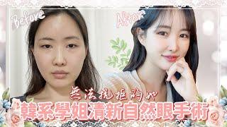 韓系學姐清新自然眼手術 ｜韓國必嫵整形醫院View Plastic Surgery