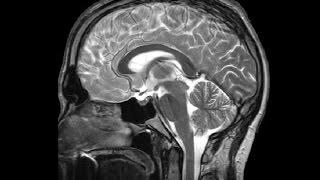 The Ventricles: Neuroanatomy Video Lab - Brain Dissections