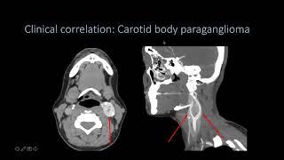 Imaging Head and neck spaces