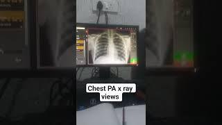chest ka pA x ray views #hostellife #radiography #radiation #tecnician #technology
