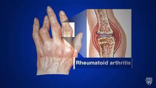 Mayo Clinic Minute What’s rheumatoid arthritis?