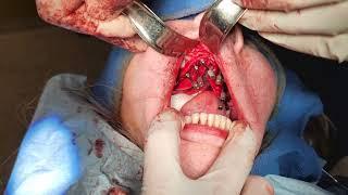 Zygomatic implant procedure, photo slideshow