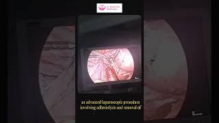 Laparoscopic Treatment of Pelvic Endometriosis with Adhesiolysis – Dr  Sushmita Mukherjee