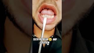 Teeth problem  and solution #teethsmile #smiledental #dentalclinic #smile #smiledentist #dentist