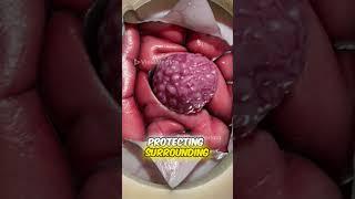 Removing a Brain Tumor (3D Animation)