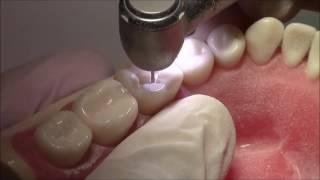 Tutorial on Class I Cavity Preparation Amalgam Restoration - DENTALKART