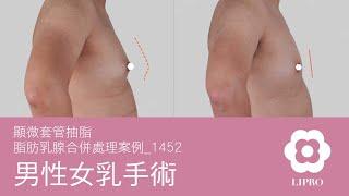 男性女乳手術｜顯微套管抽脂｜脂肪乳腺合併處理案例_1452