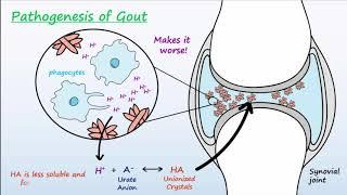 Gout - Mechanisms & Treatment