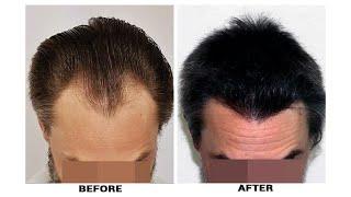 Latest Hair Transplant Results in Sep-Oct 2021 from ForHair's Patients